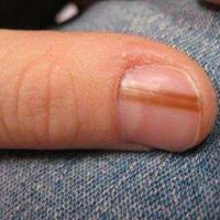 
	Longitudinal melanonychia - a subungual benign…
