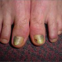 
	Nail trauma caused by football
