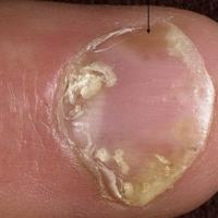 
	Nail psoriasis with oil drop (arrow)