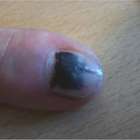 
	Subungual haematoma