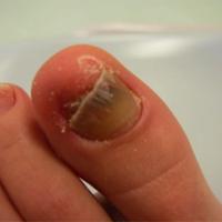 
	Same patient as previous image - nail clipped…
