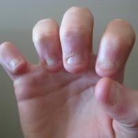 
	Nail biting
