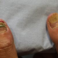 
	Onycholysis and secondary pseudomonal infection 