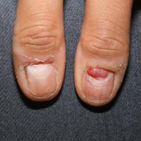 
	Pyogenic granuloma caused by nail biting

	Such…