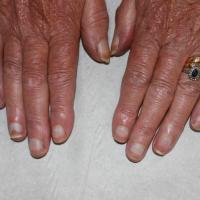 
	Terry's nails secondary to thyroid disease