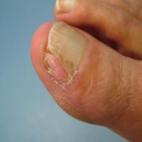 
	A periungual fibroma associated with tuberous…