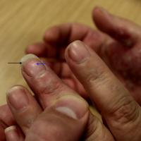 
	Nail psoriasis

	Onycholysis (black arrow),…