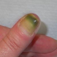 
	Pseudomonal infection 