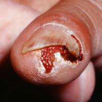 
	Squamous cell carcinoma