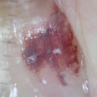 
	Subungual haematoma - dermoscopic appearance