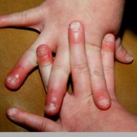 
	Twenty-nail dystrophy