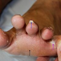 
	Tinea pedis and tinea unguium

	Fine scaling of…