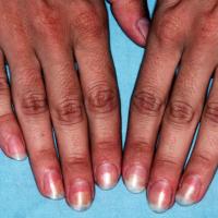 
	Photo-onycholysis secondary to a tetracycline