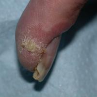 
	Bowen's disease