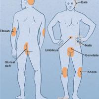 
	Psoriasis - commonly affected sites

	Examining…