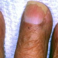 
	Half-and-half nails