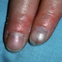 
	Nail pigmentation caused by hydroxyurea