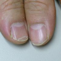 
	Lamellar nail dystrophy