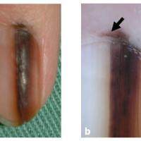 
	Subungual melanoma and Hutchinson's sign