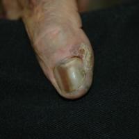
	Subungal melanoma

	Hutchinson's sign is…