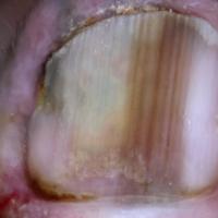 
	Dermoscopic image of the previous image
