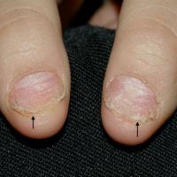
	Nail psoriasis

	Subungual hyperkeratosis…