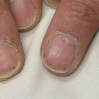 
	Splinter haemorrhages