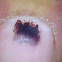
	Subungual haematoma - dermoscopic…