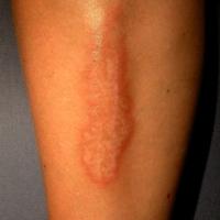
	Necrobiosis lipoidica

	White atrophic centre