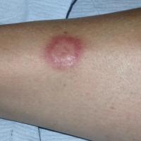 
	Necrobiosis lipoidica

	An early lesion with…