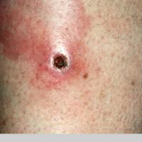 
	Necrobiosis lipoidica - ulcerated