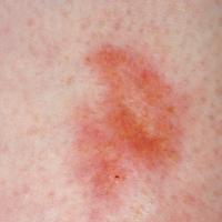 
	Necrobiosis lipoidica

	An early lesion,…