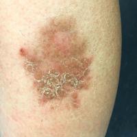 Necrobiosis lipoidica&nbsp;
Copied with…