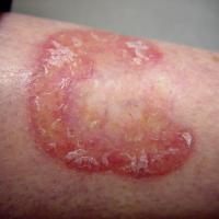 
	Necrobiosis lipoidica 

	A very characteristic…