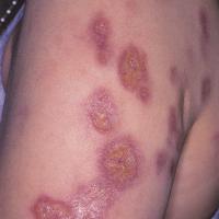 
	Sarcoidosis

	Cutaneous sarcoid presents in…