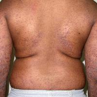 
	Keratosis lichenoides chronica