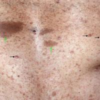 
	NF1

	Cutaneous neurofibromas (black arrows)…