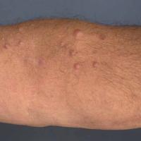 
	Segmental neurofibromatosis