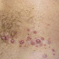 
	Segmental neurofibromatosis