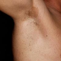 
	Axillary freckling

	Copied with kind…