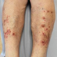 
	Nodular prurigo
