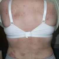 
	Nodular pruriginous eczema

	This patient with…
