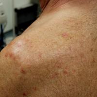 
	Papular prurigo