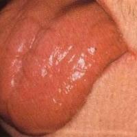 
	Atrophic glossitis