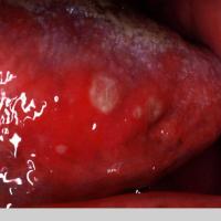 
	Beh&ccedil;et syndrome