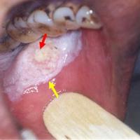 
	Oral leukoplakia with squamous cell carcinoma…