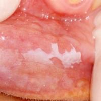 
	Oral leukoplakia (homogenous type)
