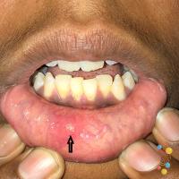 Minor aphthous ulcer&nbsp;
Copied with kind…