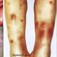 
	Beh&ccedil;et syndrome
