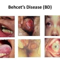 
	Beh&ccedil;et syndrome